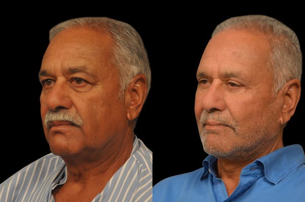 Changes Rapid Lift For Men Before & After Gallery - Patient 300955 - Image 1