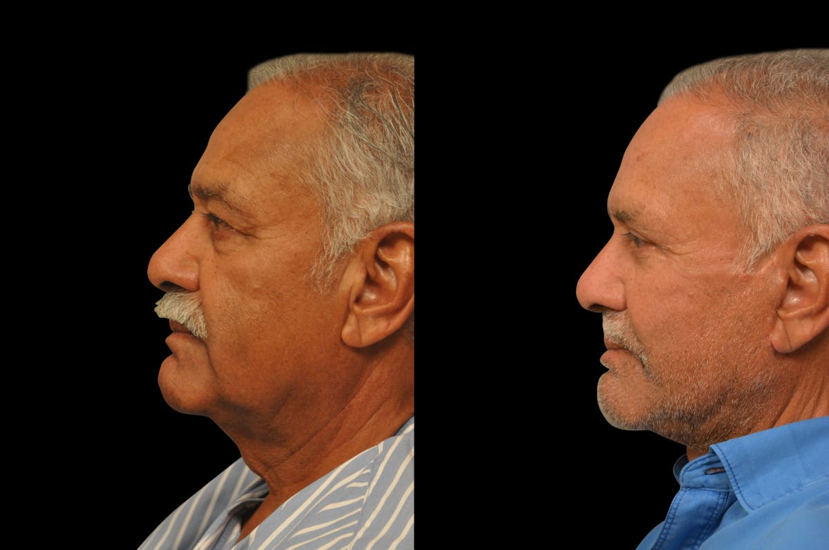 Eyelid Procedures Before & After Gallery - Patient 374701 - Image 3