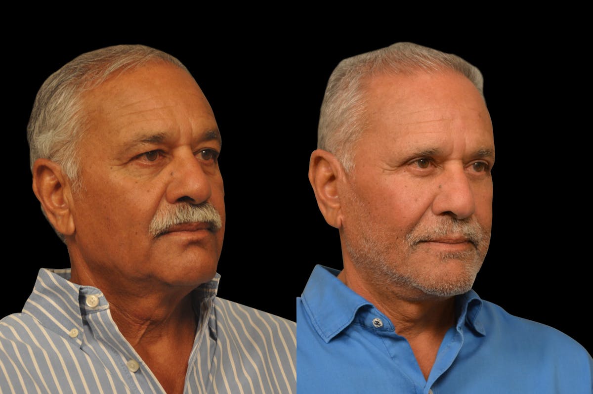 Changes Rapid Lift For Men Before & After Gallery - Patient 300955 - Image 3