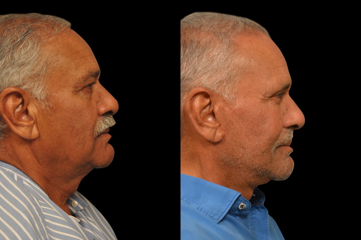 Eyelid Procedures Before & After Gallery - Patient 374701 - Image 5
