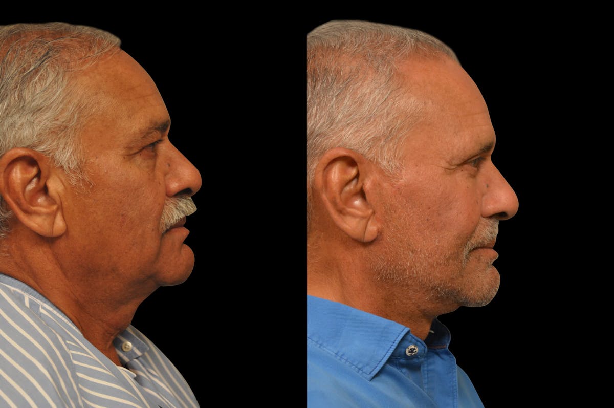 Changes Rapid Lift For Men Before & After Gallery - Patient 300955 - Image 4