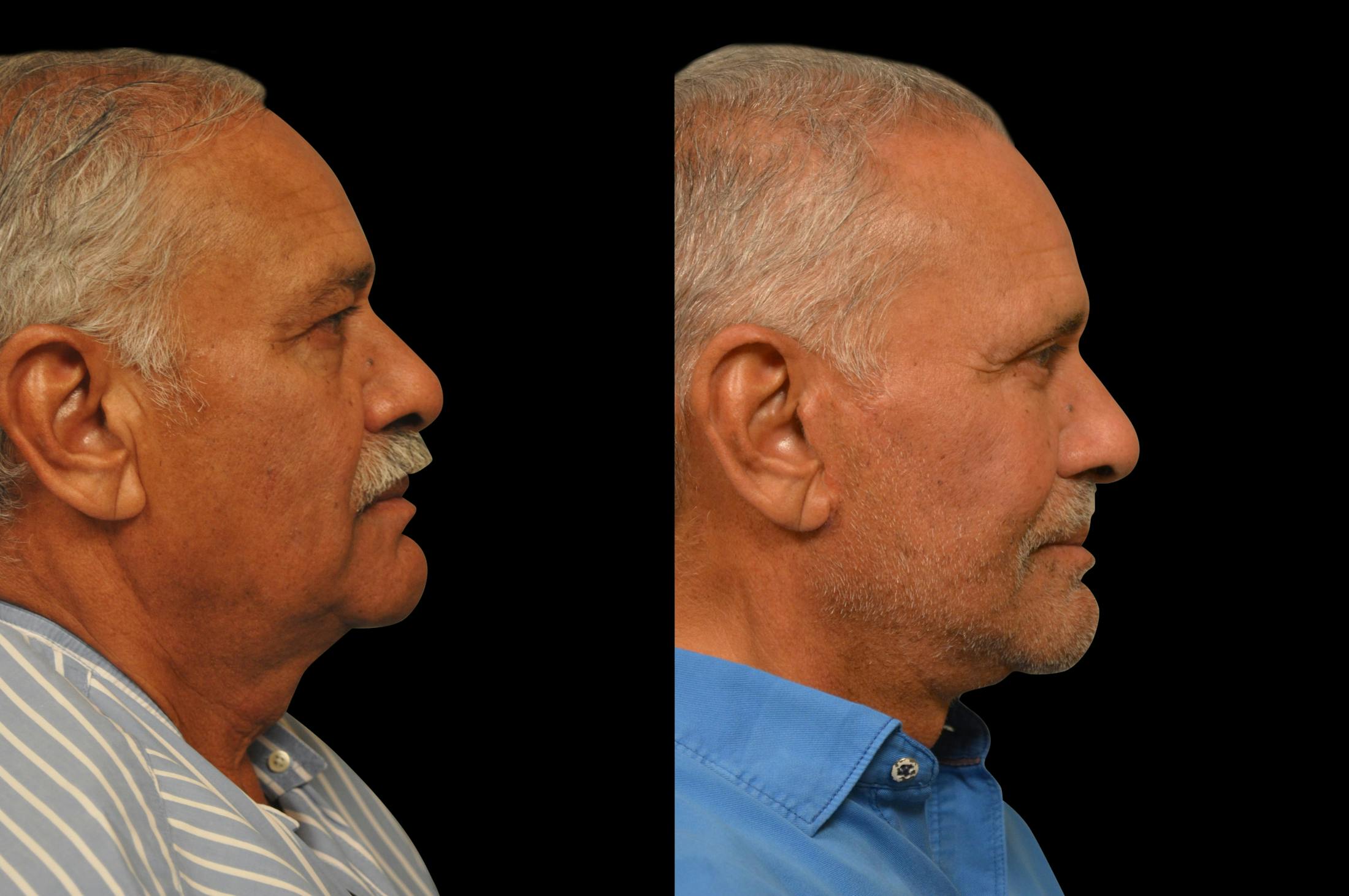 Eyelid Procedures Before & After Gallery - Patient 374701 - Image 5