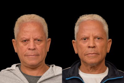 Eyelid Procedures Before & After Gallery - Patient 411822 - Image 1