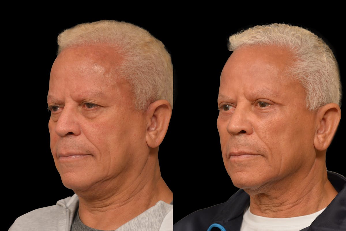 Eyelid Procedures Before & After Gallery - Patient 411822 - Image 2