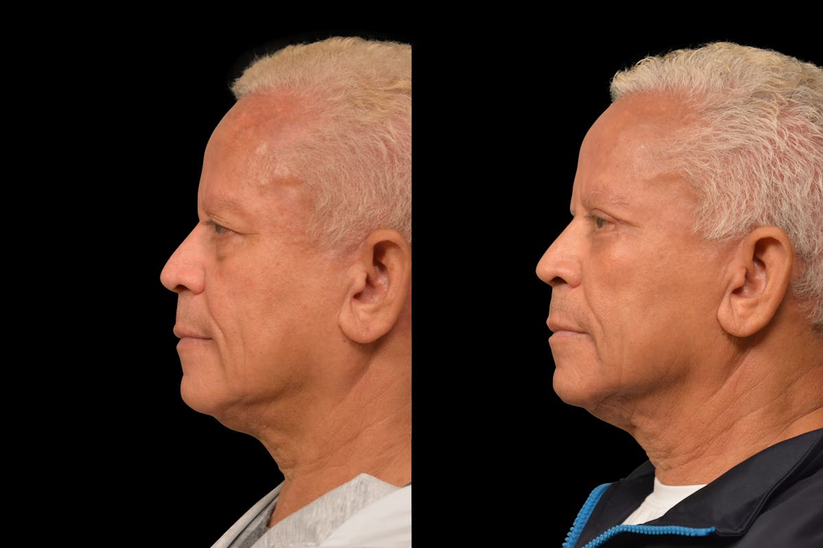 Eyelid Procedures Before & After Gallery - Patient 411822 - Image 3