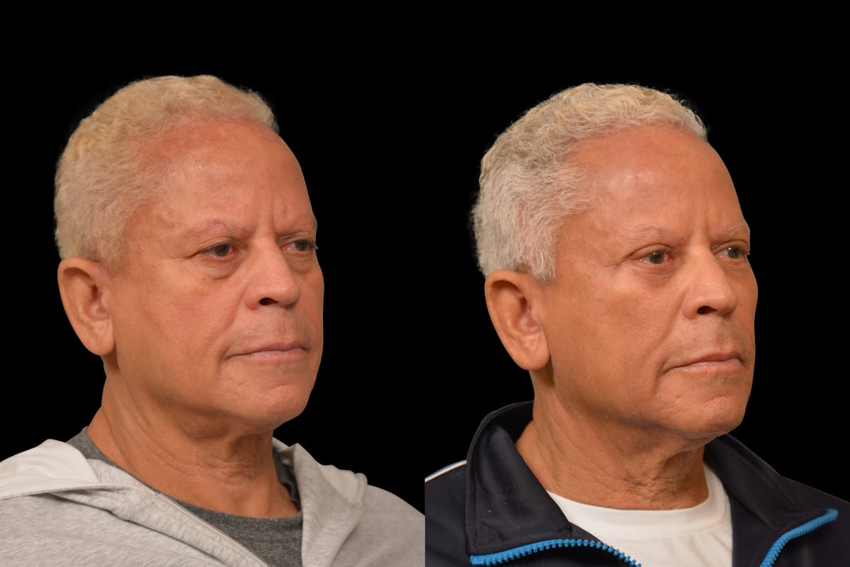 Eyelid Procedures Before & After Gallery - Patient 411822 - Image 4