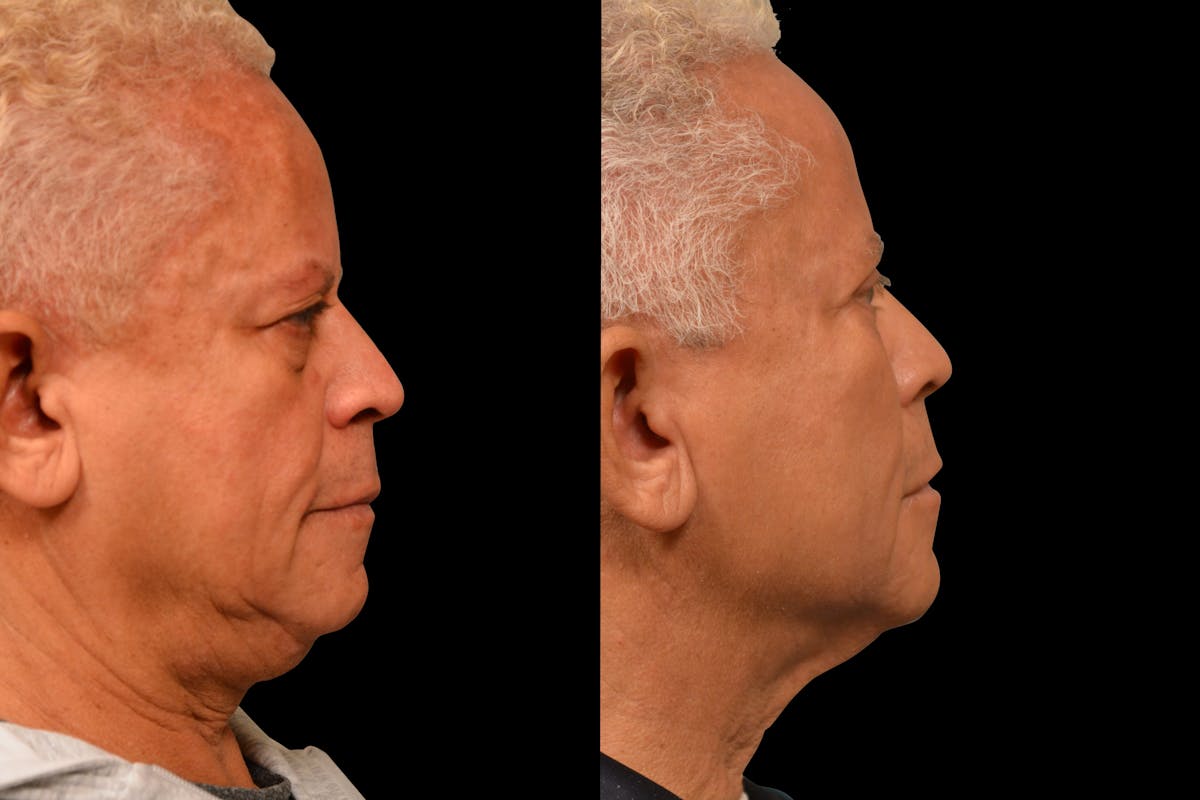 Eyelid Procedures Before & After Gallery - Patient 411822 - Image 5