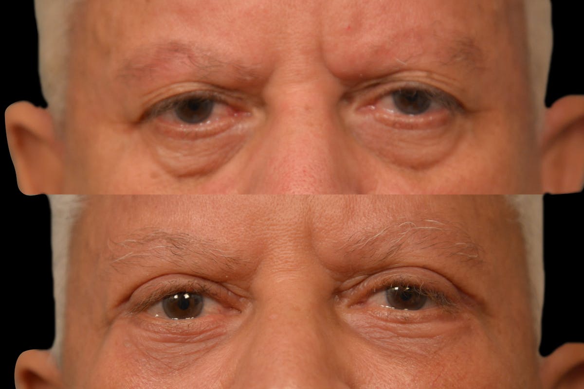 Eyelid Procedures Before & After Gallery - Patient 411822 - Image 6