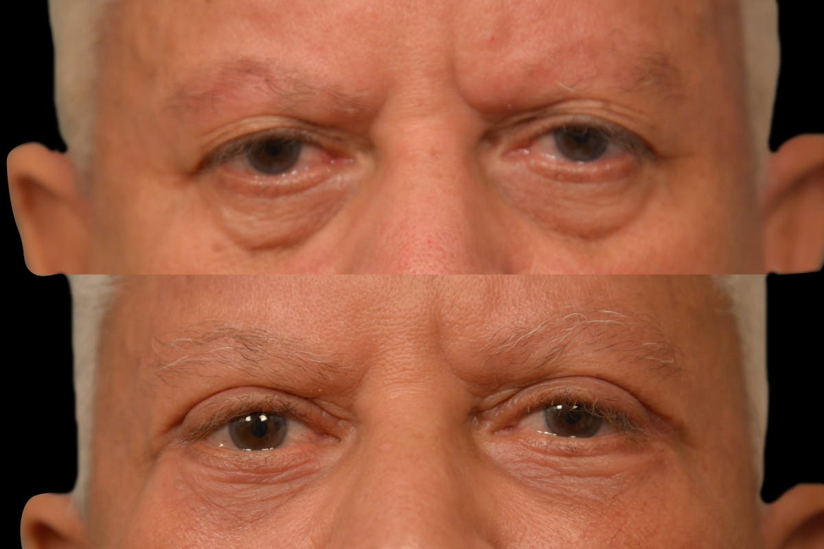 Eyelid Procedures Before & After Gallery - Patient 411822 - Image 6