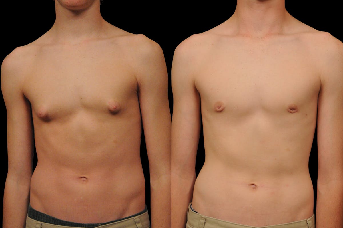 Gynecomastia Before & After Gallery - Patient 159397 - Image 1