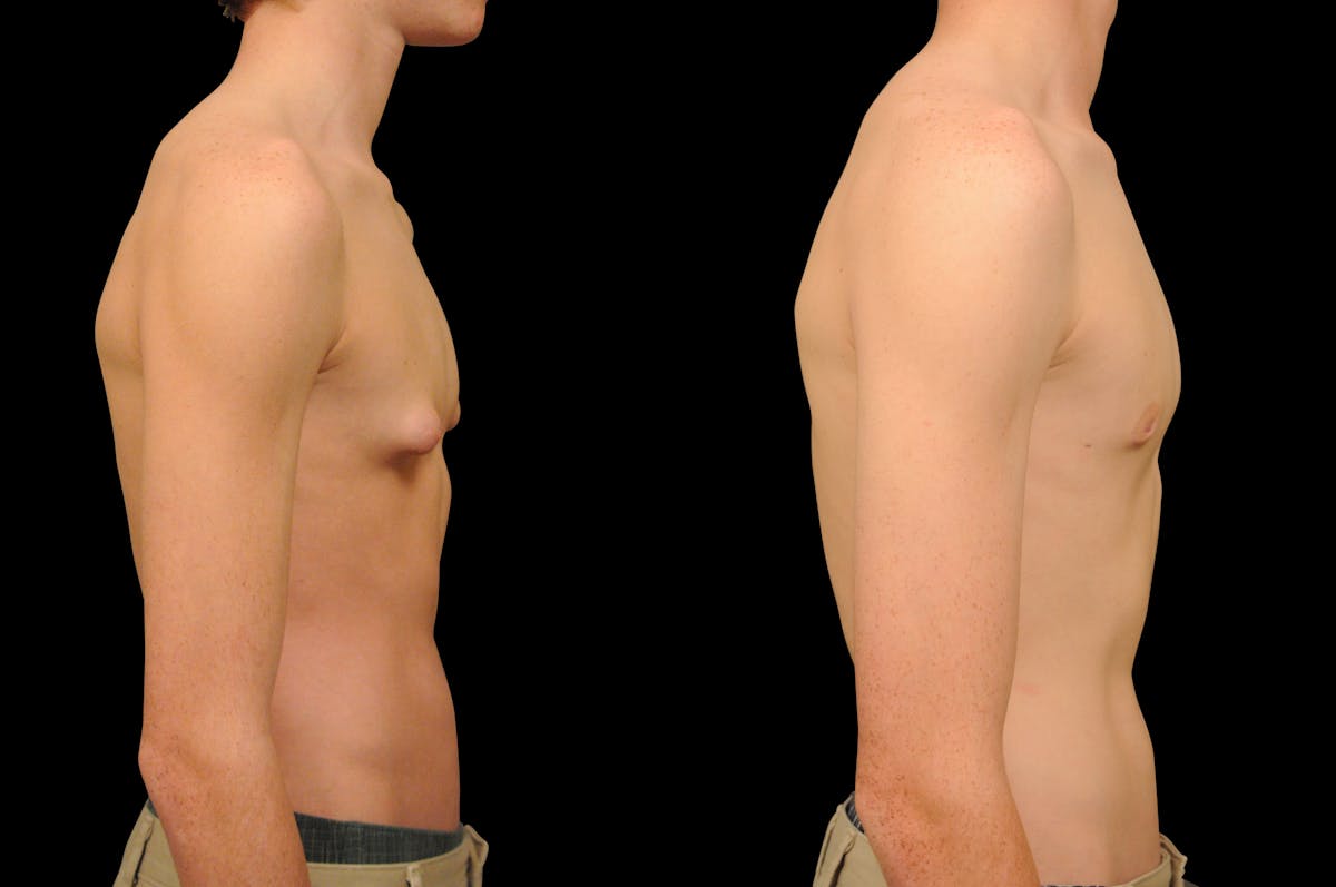 Gynecomastia Before & After Gallery - Patient 159397 - Image 2