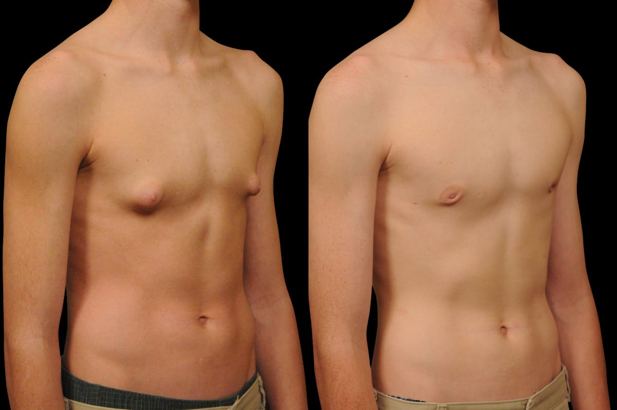 Gynecomastia Before & After Gallery - Patient 159397 - Image 3
