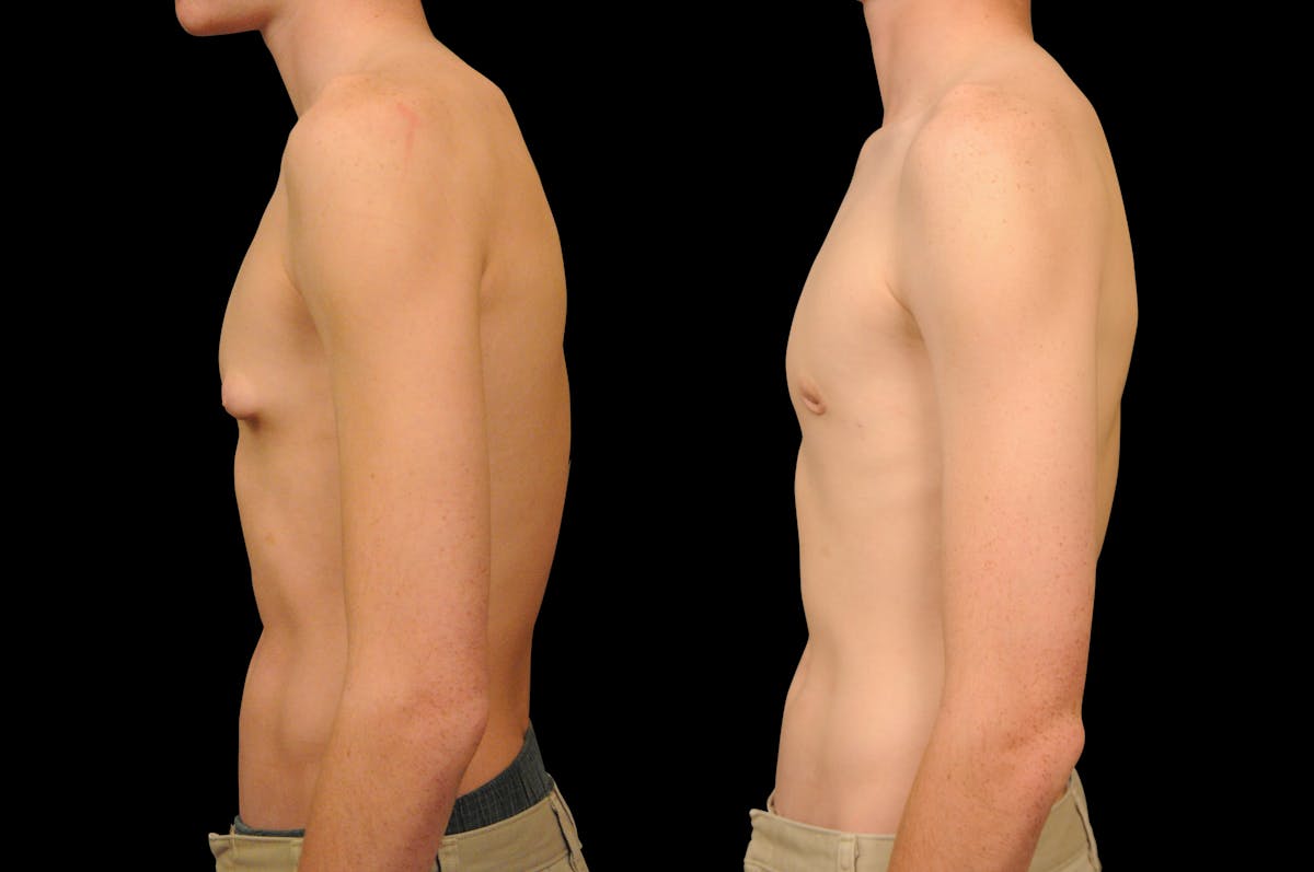 Gynecomastia Before & After Gallery - Patient 159397 - Image 4