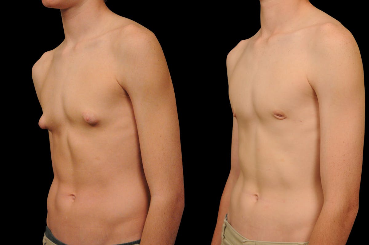 Gynecomastia Before & After Gallery - Patient 159397 - Image 5