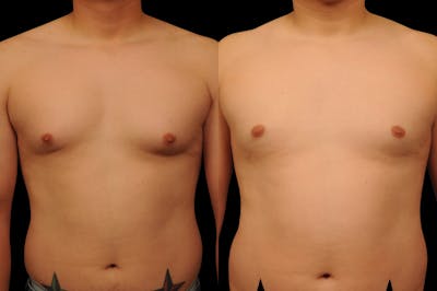 Gynecomastia Before & After Gallery - Patient 351151 - Image 1