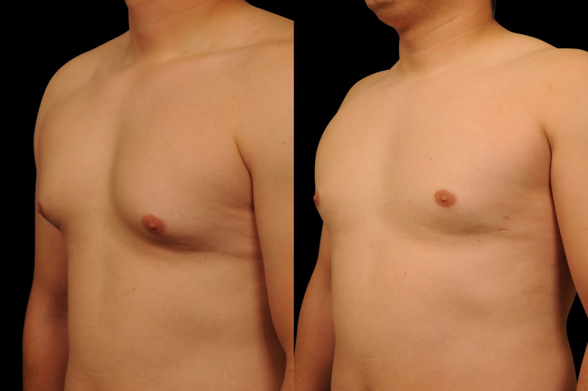 Gynecomastia Before & After Gallery - Patient 351151 - Image 2