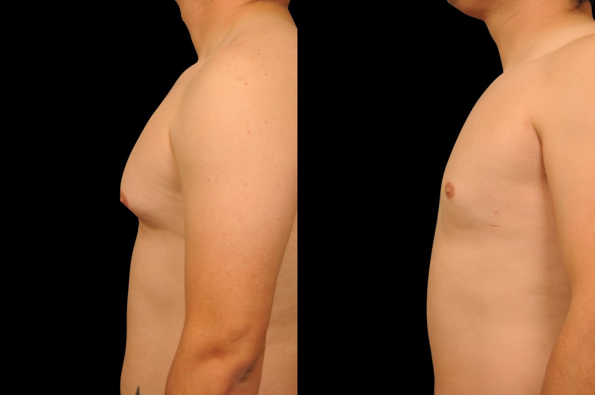 Gynecomastia Before & After Gallery - Patient 351151 - Image 3