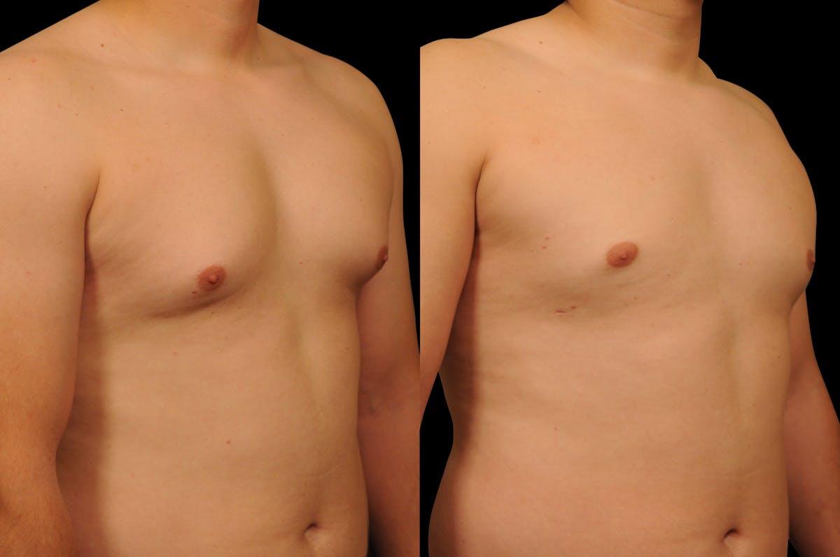Gynecomastia Before & After Gallery - Patient 351151 - Image 4