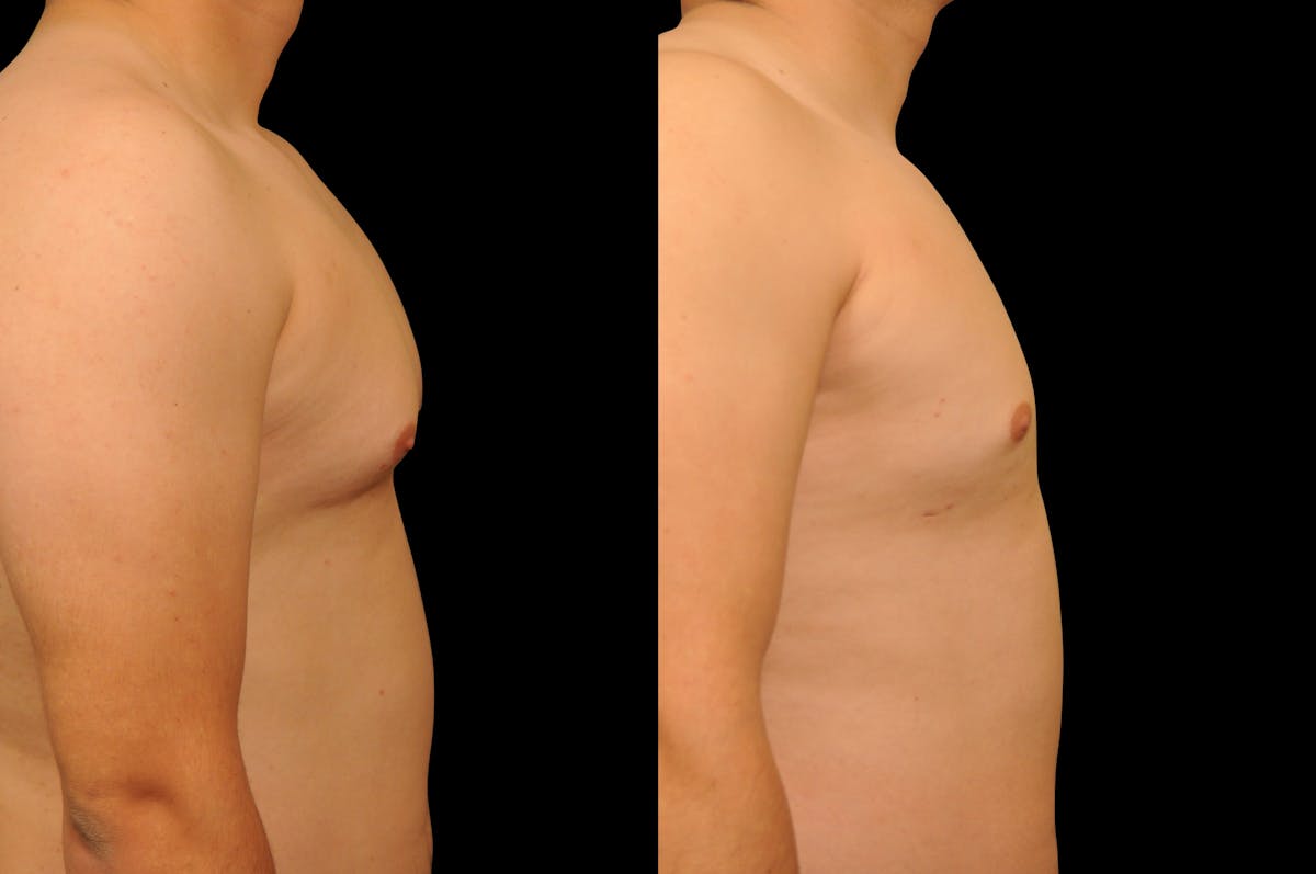 Gynecomastia Before & After Gallery - Patient 351151 - Image 5