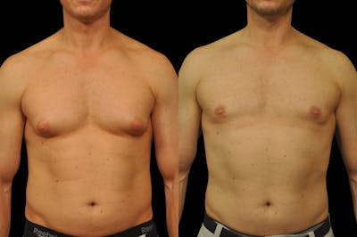 Gynecomastia Before & After Gallery - Patient 289288 - Image 1