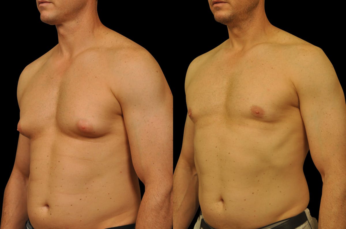 Gynecomastia Before & After Gallery - Patient 289288 - Image 2