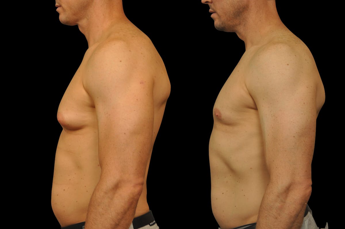 Gynecomastia Before & After Gallery - Patient 289288 - Image 3