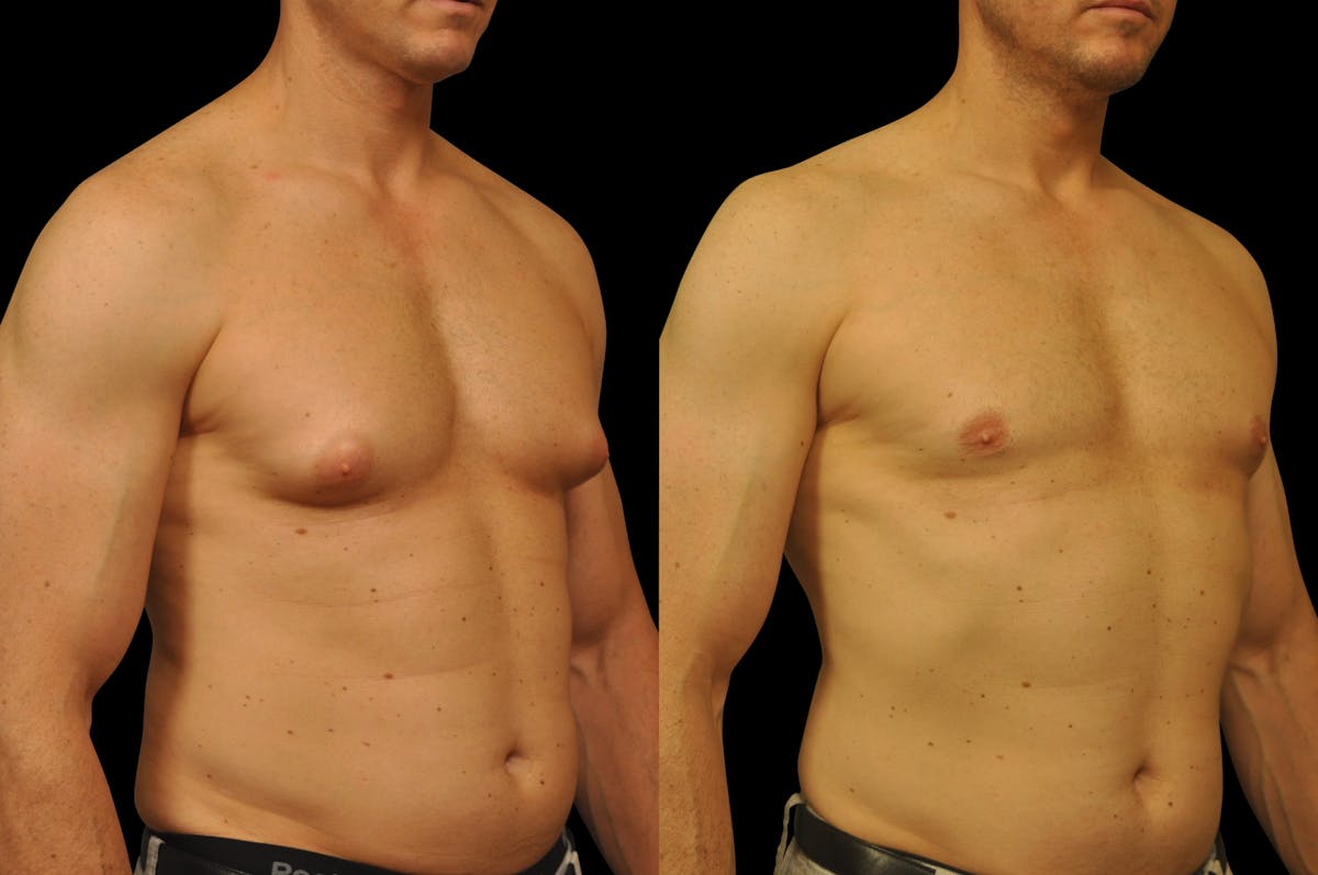 Gynecomastia Before & After Gallery - Patient 289288 - Image 4