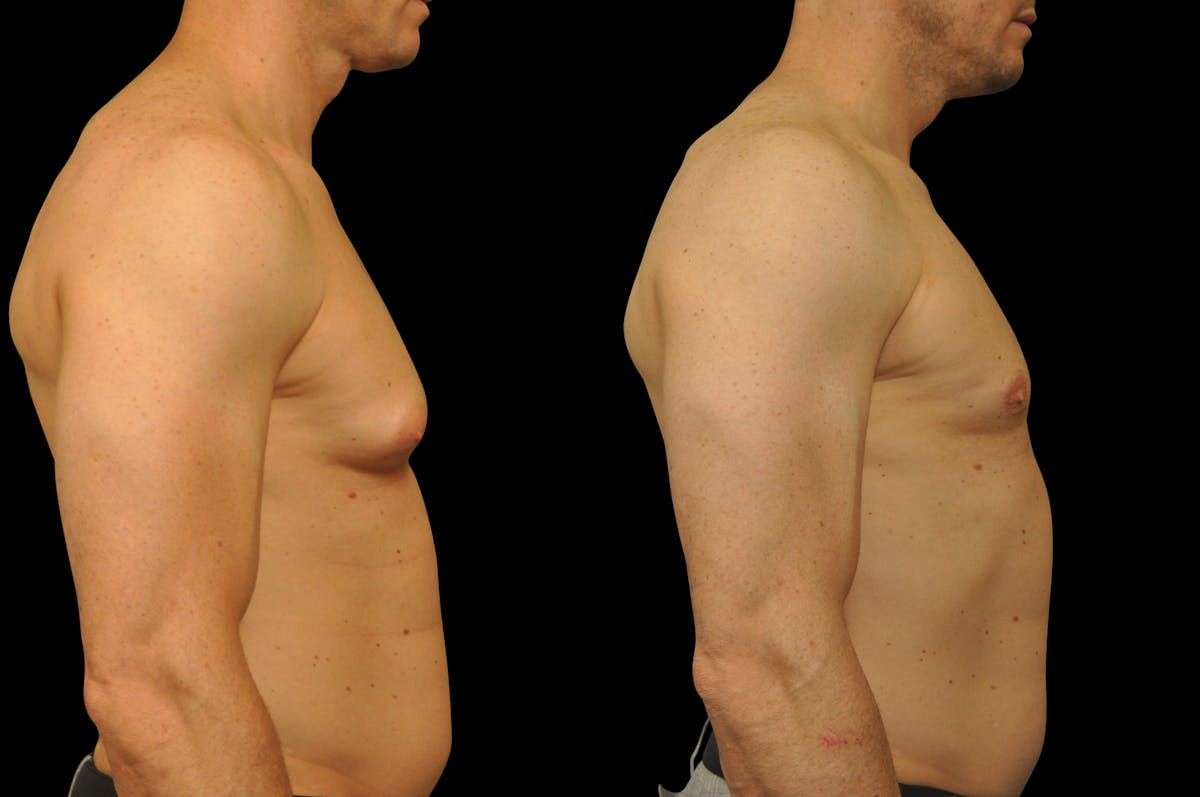 Gynecomastia Before & After Gallery - Patient 289288 - Image 5