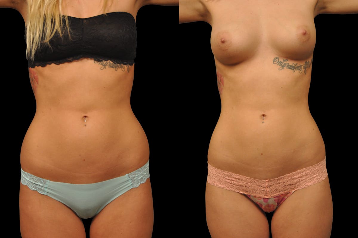 Liposuction / BodyTite Before & After Gallery - Patient 175853 - Image 1