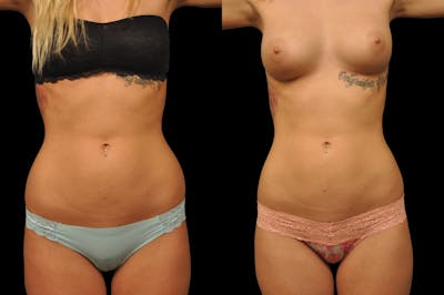 Liposuction / BodyTite Before & After Gallery - Patient 175853 - Image 1