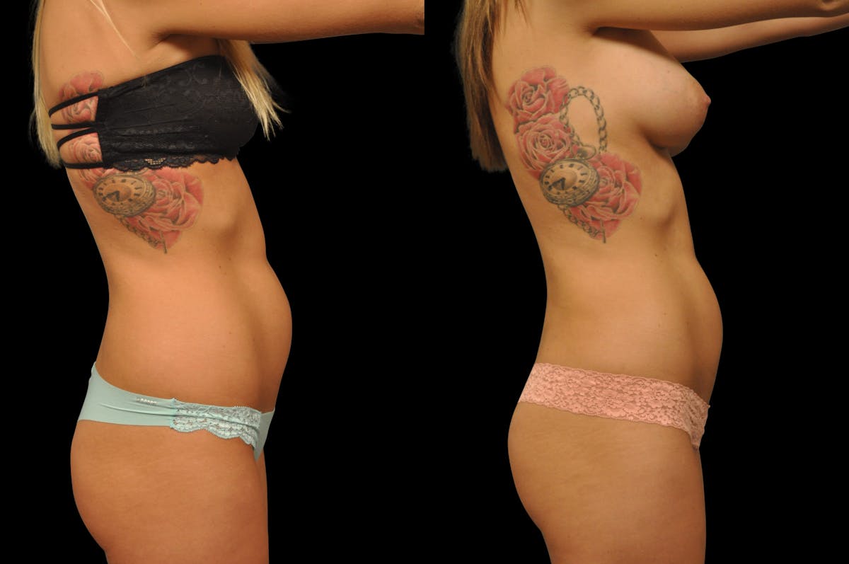 Liposuction / BodyTite Before & After Gallery - Patient 175853 - Image 3