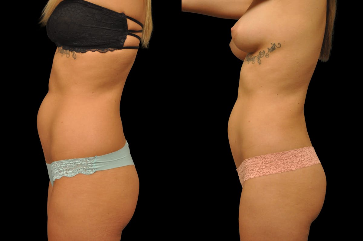 Liposuction / BodyTite Before & After Gallery - Patient 175853 - Image 5