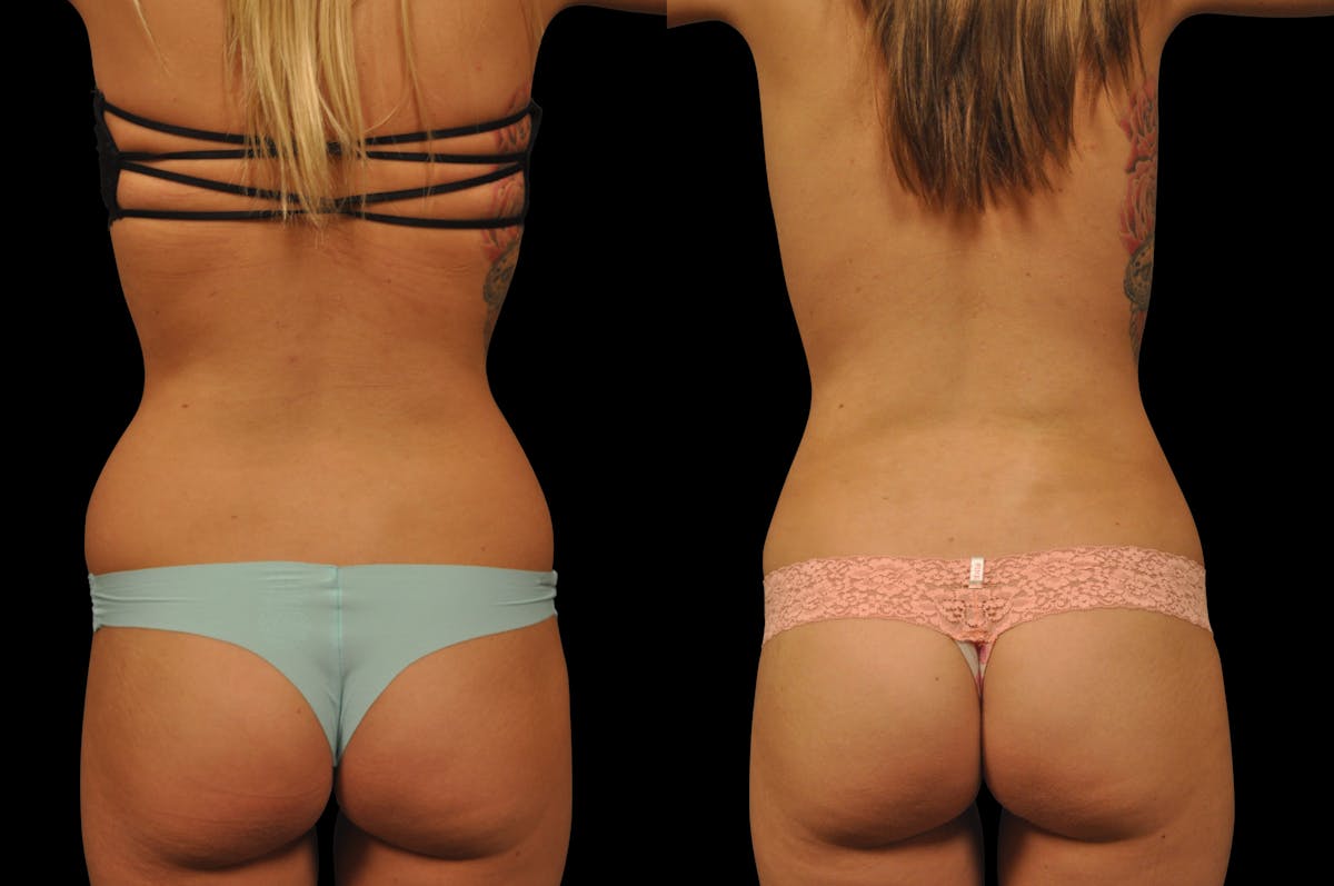 Liposuction / BodyTite Before & After Gallery - Patient 175853 - Image 6