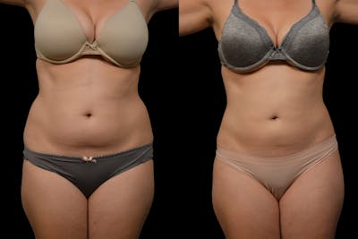 Liposuction / BodyTite Before & After Gallery - Patient 324311 - Image 1