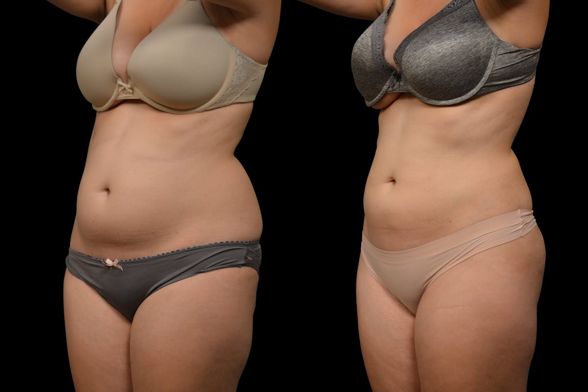 Liposuction / BodyTite Before & After Gallery - Patient 324311 - Image 2