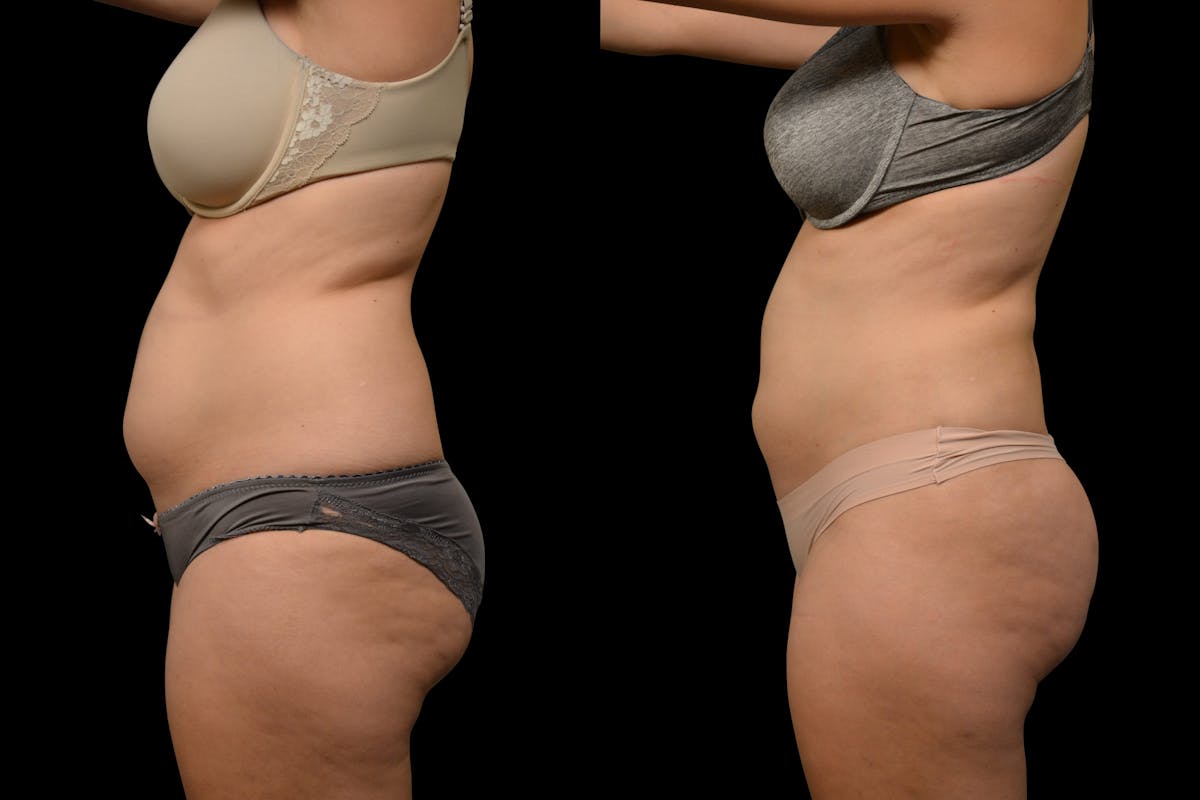Liposuction / BodyTite Before & After Gallery - Patient 324311 - Image 3