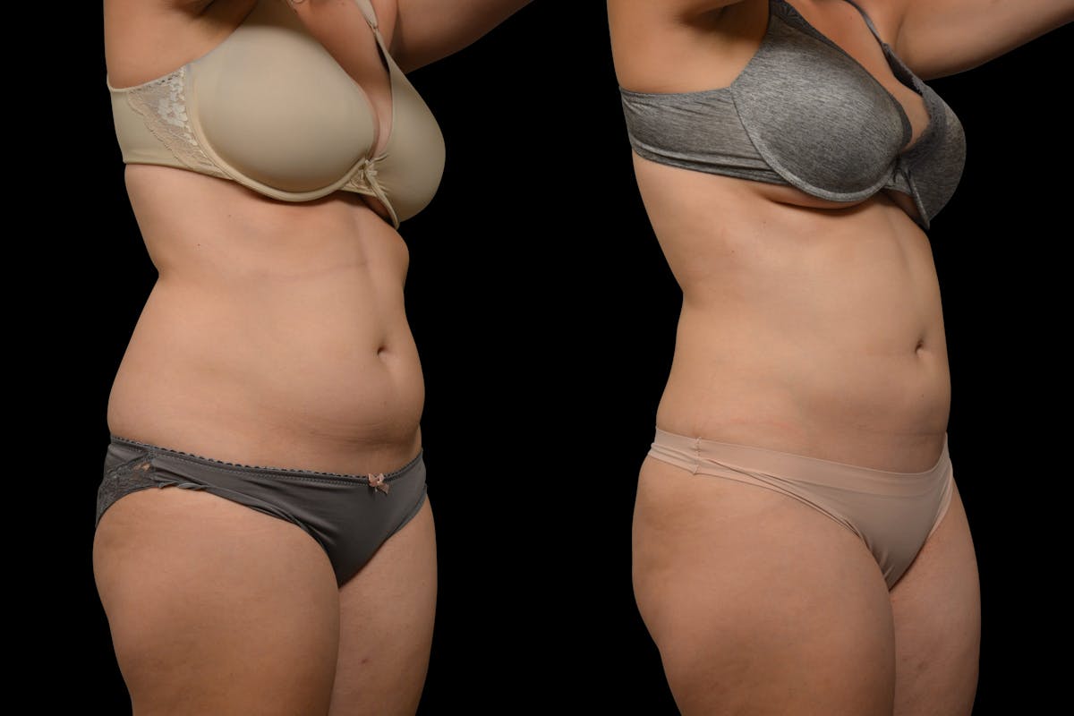 Liposuction / BodyTite Before & After Gallery - Patient 324311 - Image 4