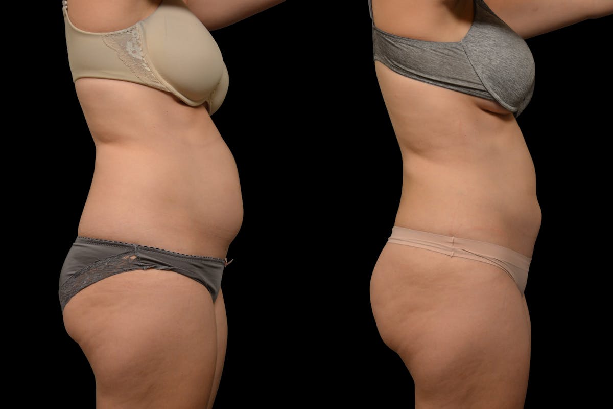 Liposuction / BodyTite Before & After Gallery - Patient 324311 - Image 5