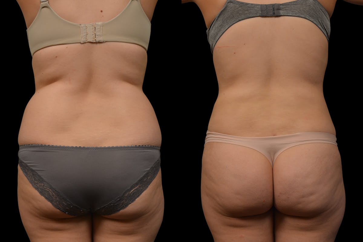 Liposuction Before & After Gallery - Patient 324311 - Image 6