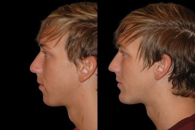 Chin Augmentation Before & After Gallery - Patient 232181 - Image 1