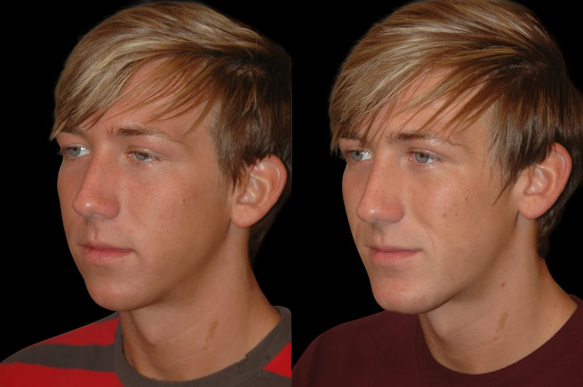 Chin Augmentation For Men Before & After Gallery - Patient 232181 - Image 2