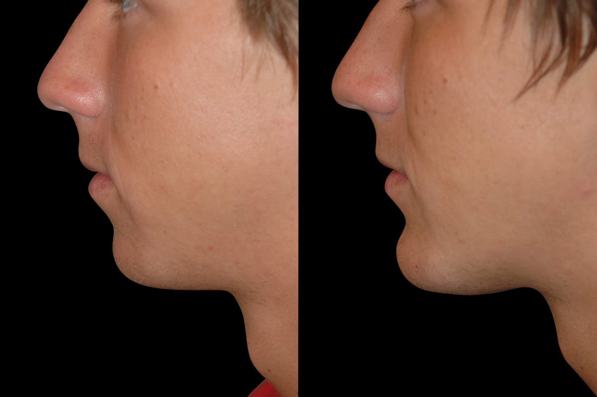 Chin Augmentation Before & After Gallery - Patient 232181 - Image 3