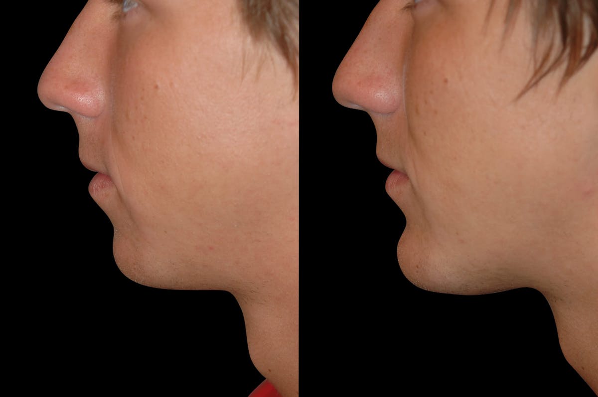 Chin Augmentation For Men Before & After Gallery - Patient 232181 - Image 3