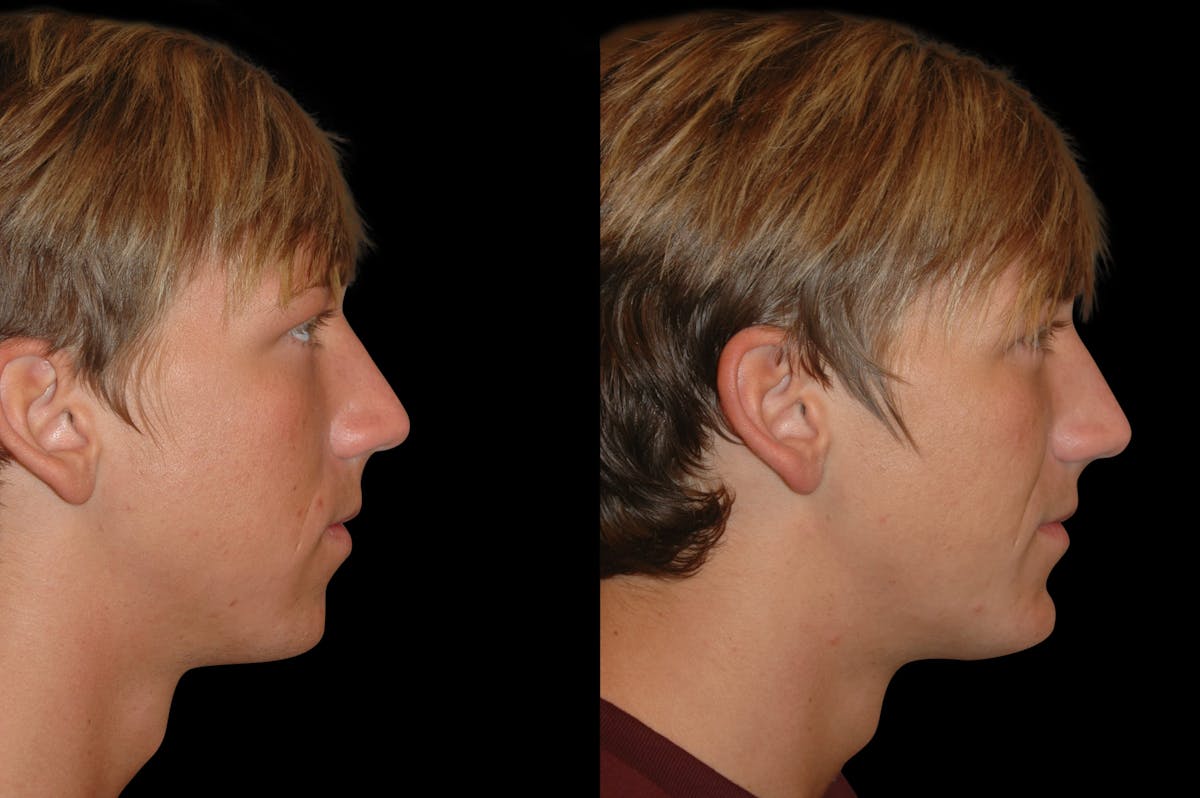 Chin Augmentation For Men Before & After Gallery - Patient 232181 - Image 4