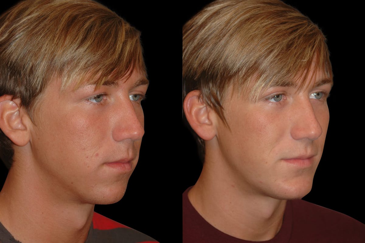 Chin Augmentation For Men Before & After Gallery - Patient 232181 - Image 5