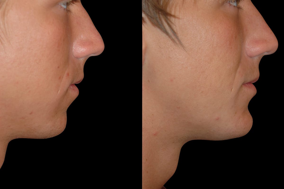 Chin Augmentation Before & After Gallery - Patient 232181 - Image 6