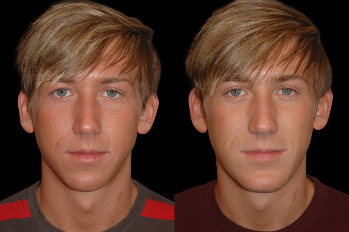 Chin Augmentation For Men Before & After Gallery - Patient 232181 - Image 7