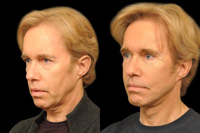 Chin Augmentation Before & After Gallery - Patient 336757 - Image 1