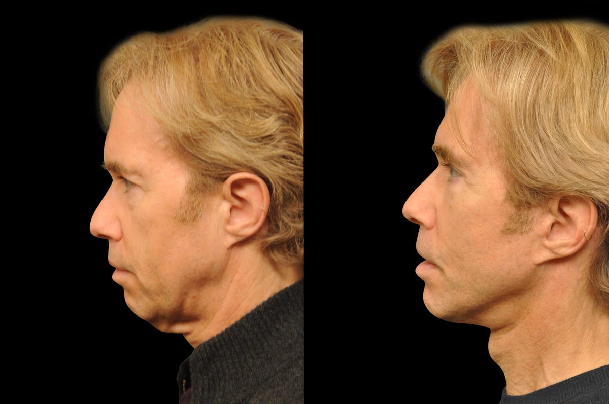 Chin Augmentation Before & After Gallery - Patient 336757 - Image 2