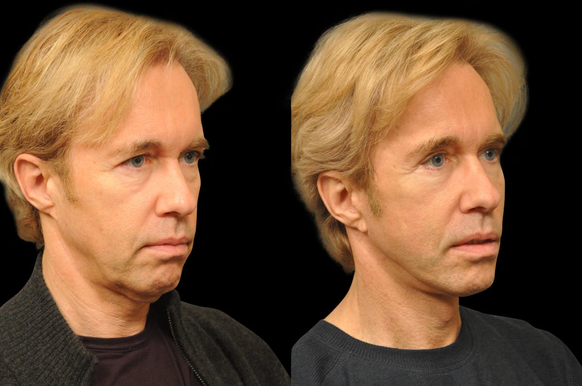Changes Rapid Lift For Men Before & After Gallery - Patient 235434 - Image 3